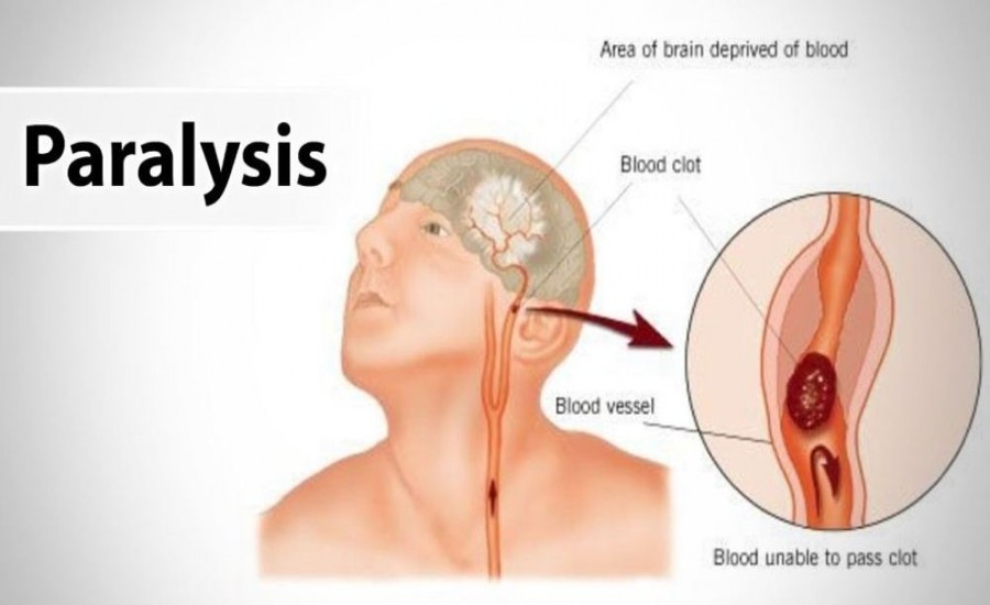 Paralysis