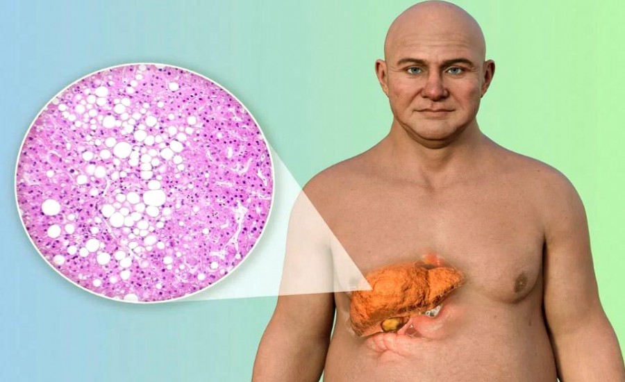 लिवर को खराब कर सकती हैं मीठी चीजें!